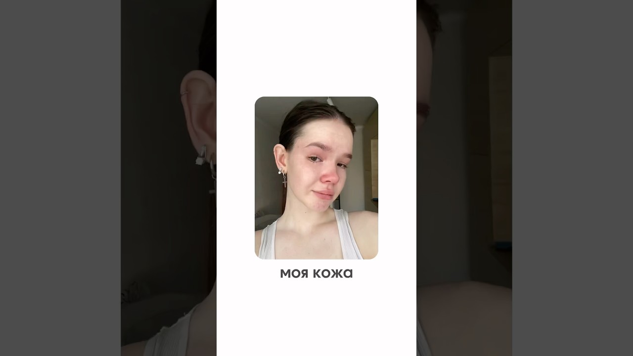 историю моего акне рассказала в тгк: косточка #акне #ретиноиды #системныеретиноиды
