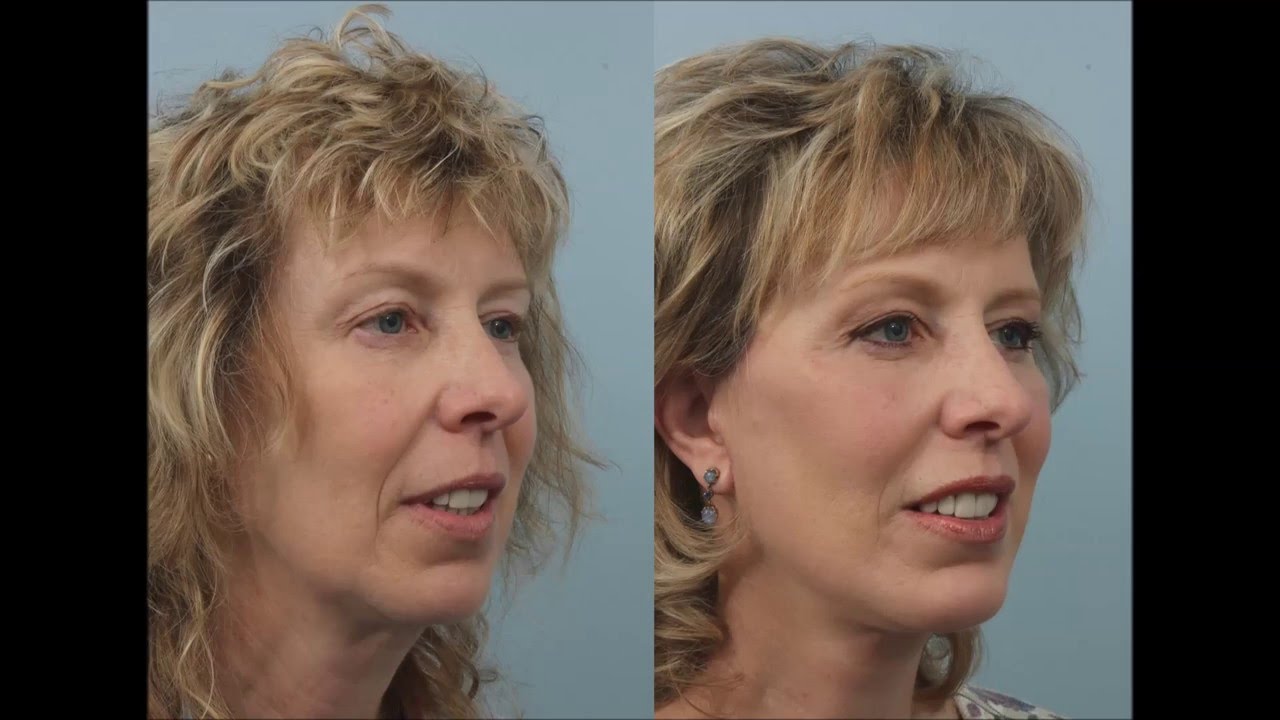 Fireside Chats with Dr. Edwin Williams Recovery Following a Facelift