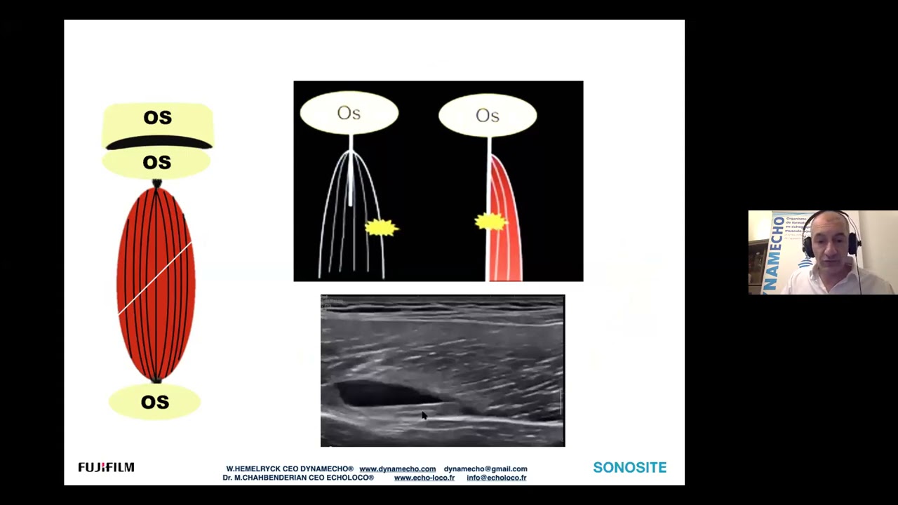 Echographie et traumatismes musculaires aigus chez le sportif le quadriceps
