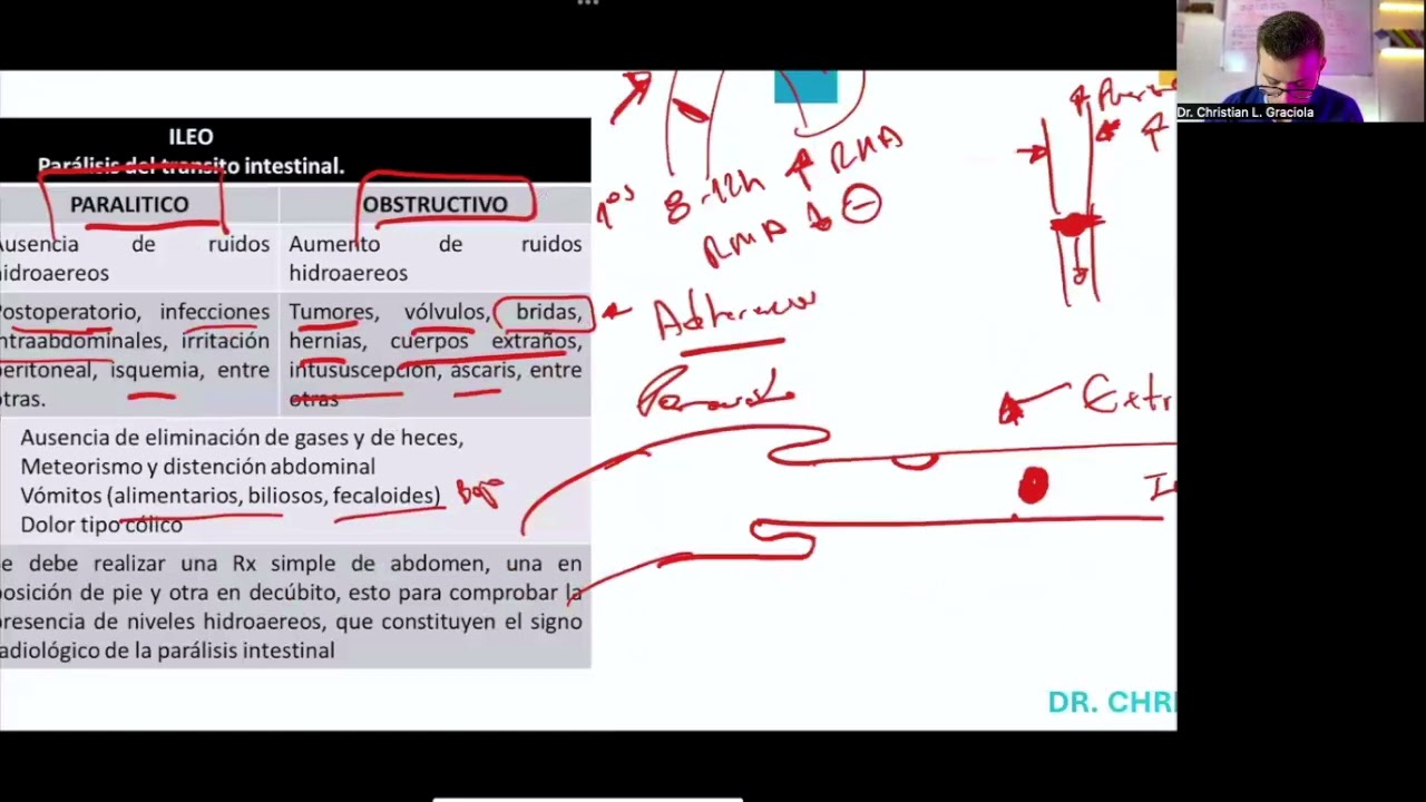 Obstruccion Intestinal
