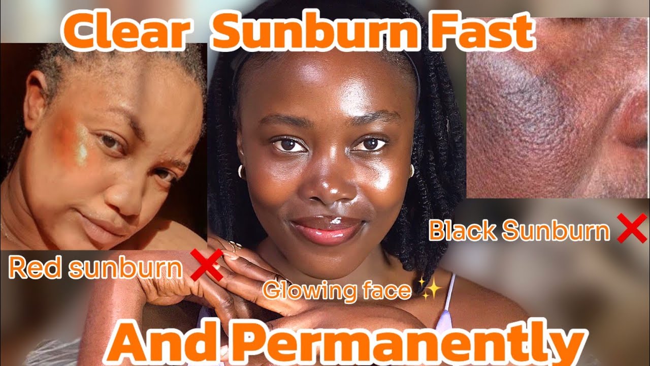 Sunburn treatment creams for face  ✅ | How to clear sunburn permanently 