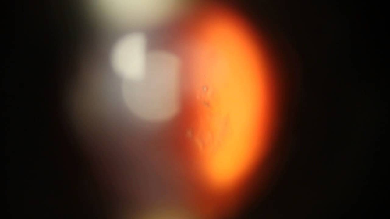 Floaters - Vitreolysis - Floater removal with the Ellex YAG Laser performed by Dr. Paul Singh