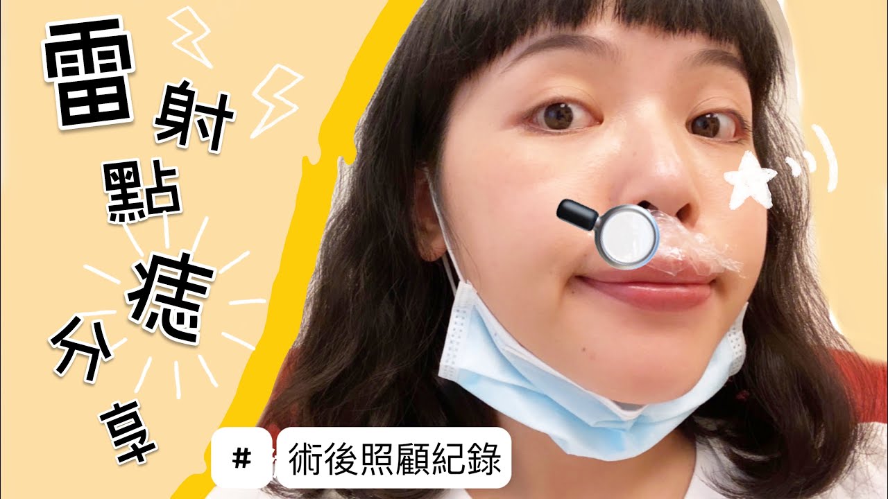 雷射點痣│雷射點痣紀錄✨點痣會不會痛？💥點痣術後照顧💗│Meigo