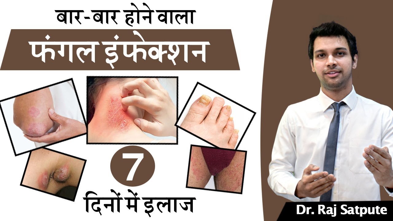 दो टिप्स जिससे फंगल इन्फेक्शन वापस कभी नहीं आता | How to Get Rid of Any Skin Infection in Hindi