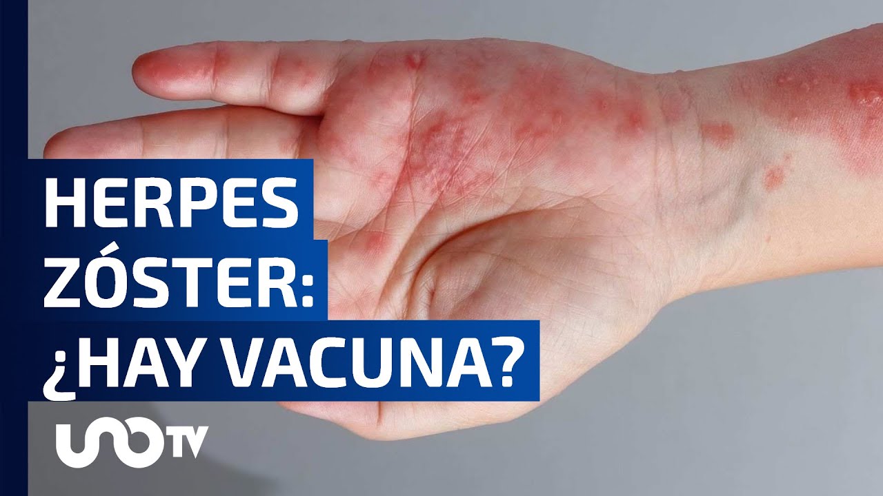Herpes Zóster: ¿Cuándo es conveniente vacunarse?