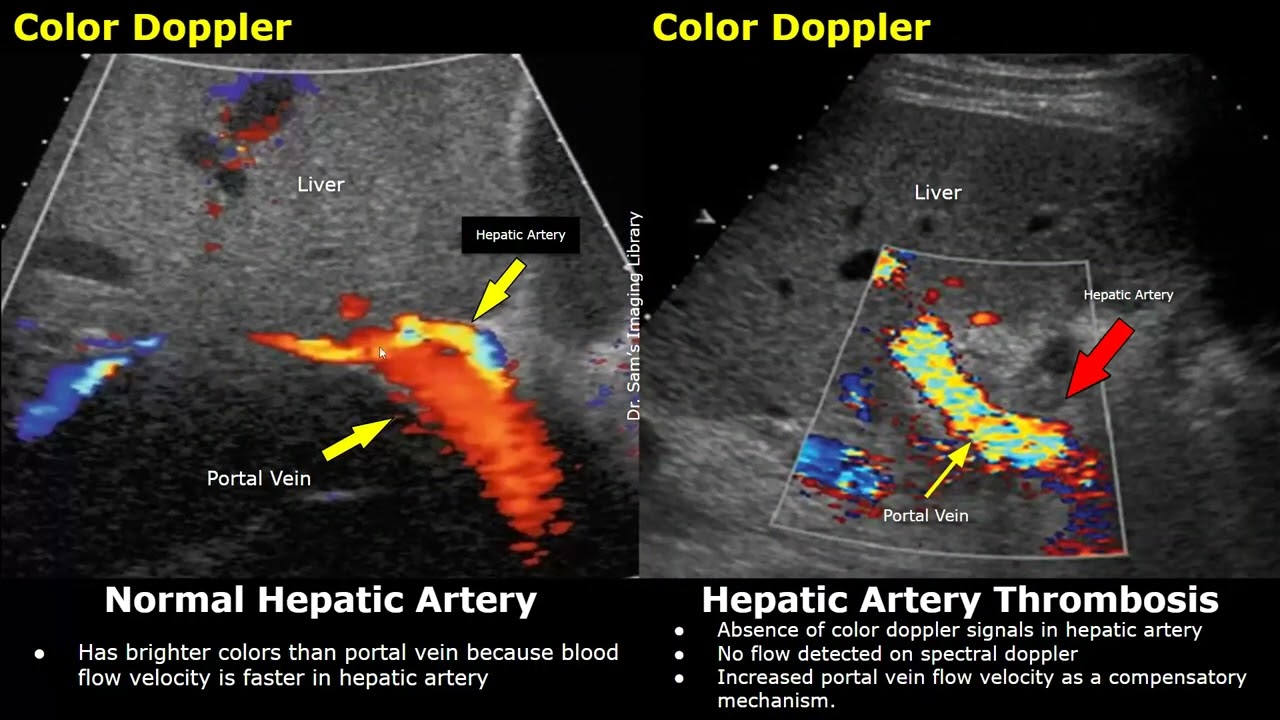 Hepatic Artery Spectral/Color Doppler Ultrasound Normal Vs Abnormal | Liver Transplant & Other Cases