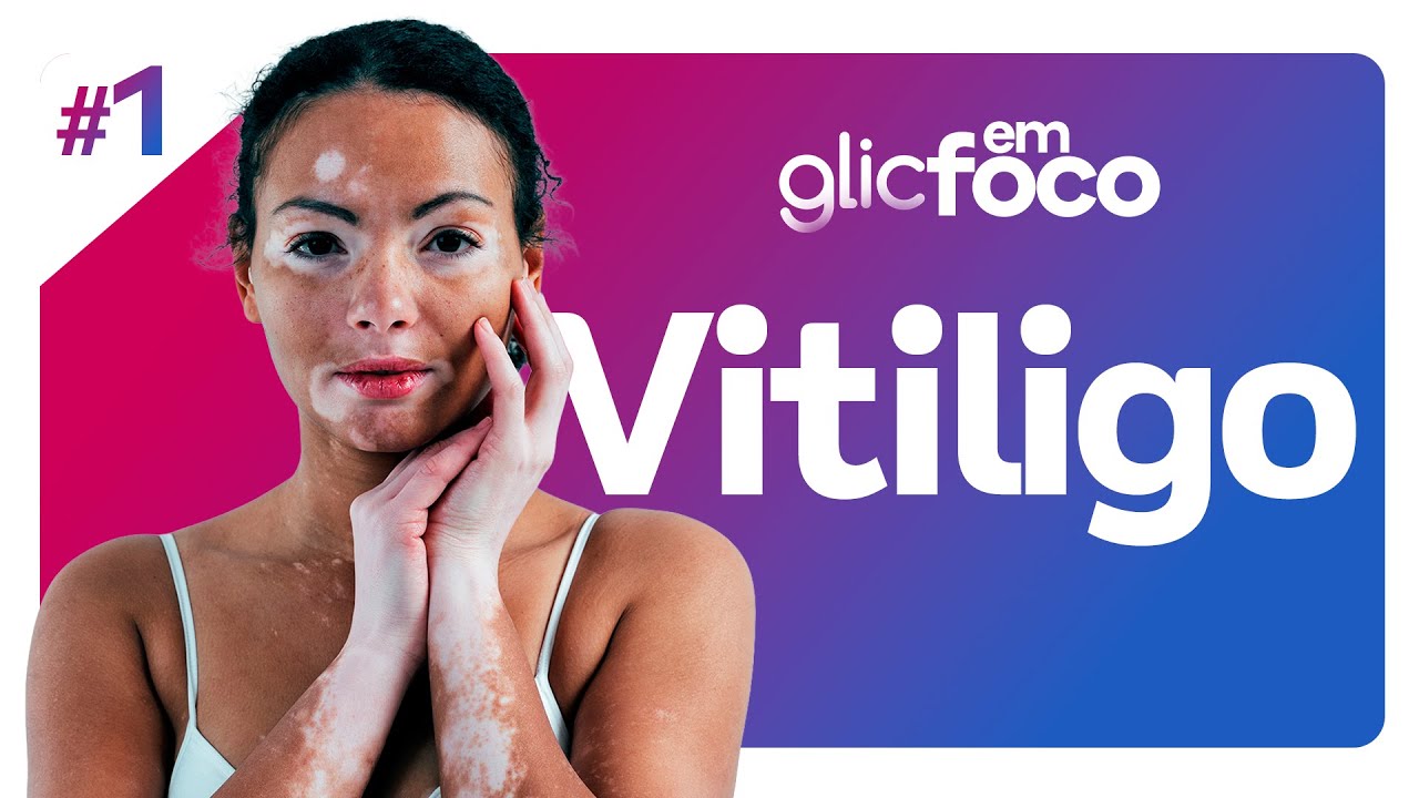 Vitiligo | Glic em Foco #1