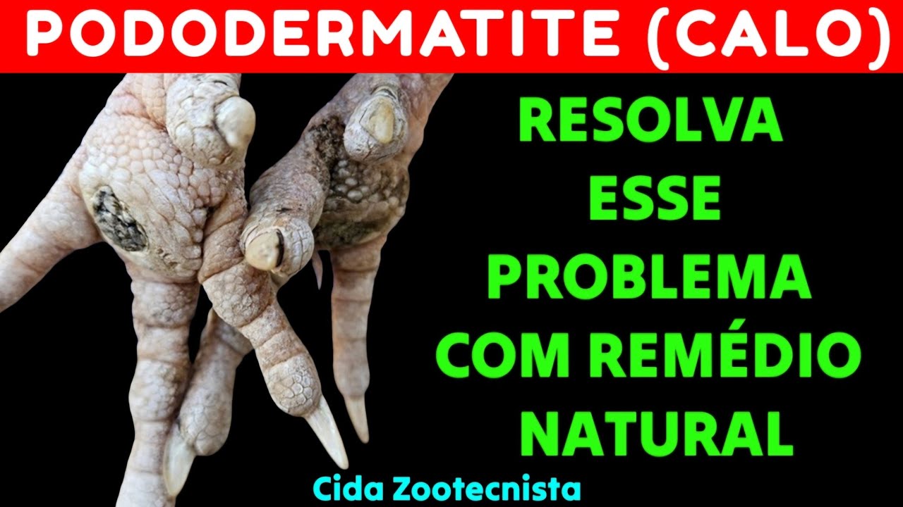 PODODERMATITE (CALO). RESOLVA ESSE PROBLEMA COM REMÉDIO NATURAL