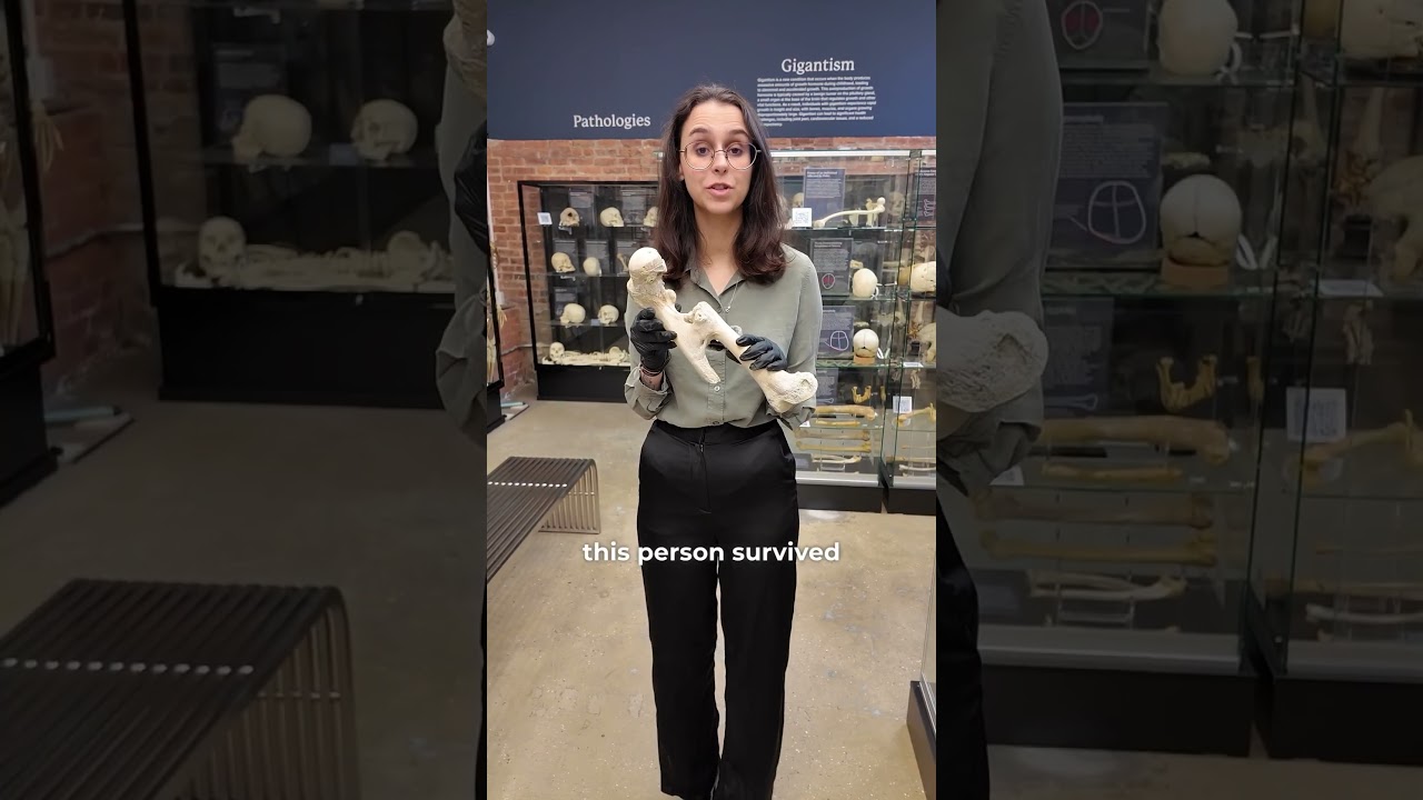 Что такое неправильно сросшийся перелом бедренной кости?