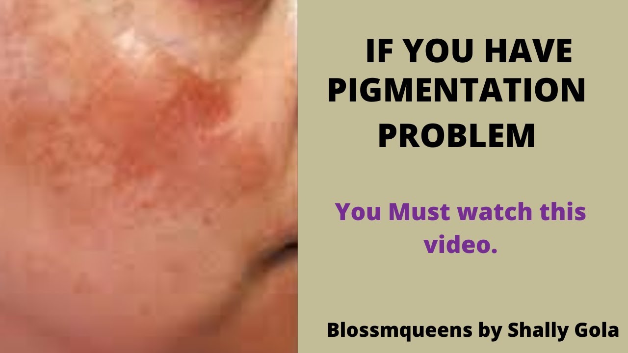 How to reduce pigmentation|Optimals Even Out range| Best cream for pigmentation|by Shally Gola