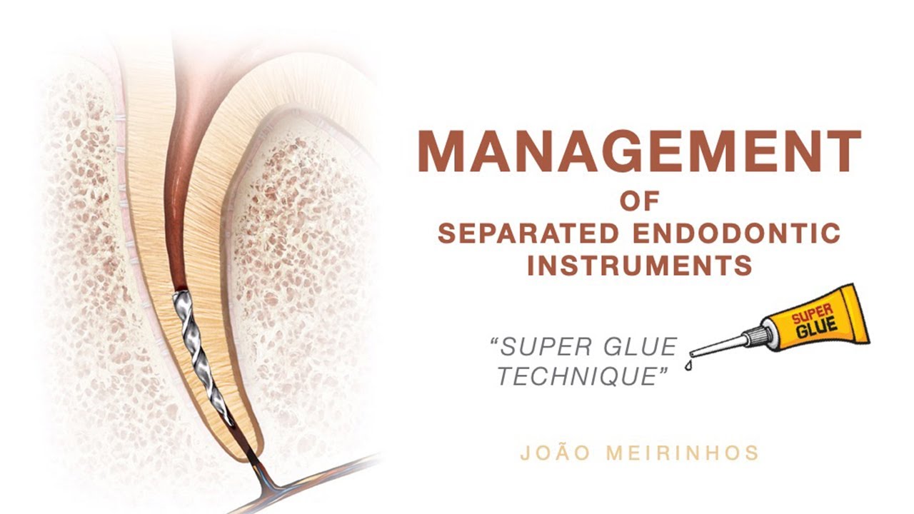“SUPER GLUE TECHNIQUE” to remove a separated instrument from the root canal system