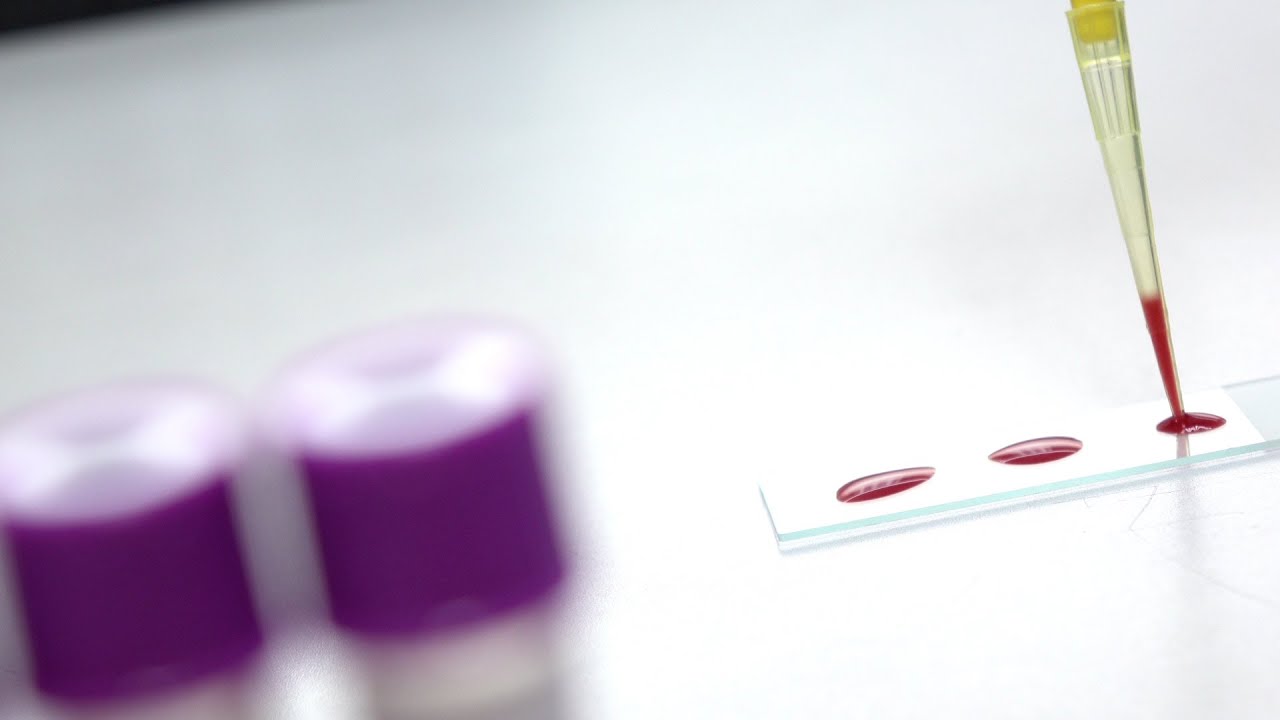 Malattie metaboliche da accumulo lisosomiale:  lo screening neonatale può salvare la vita ai bambini