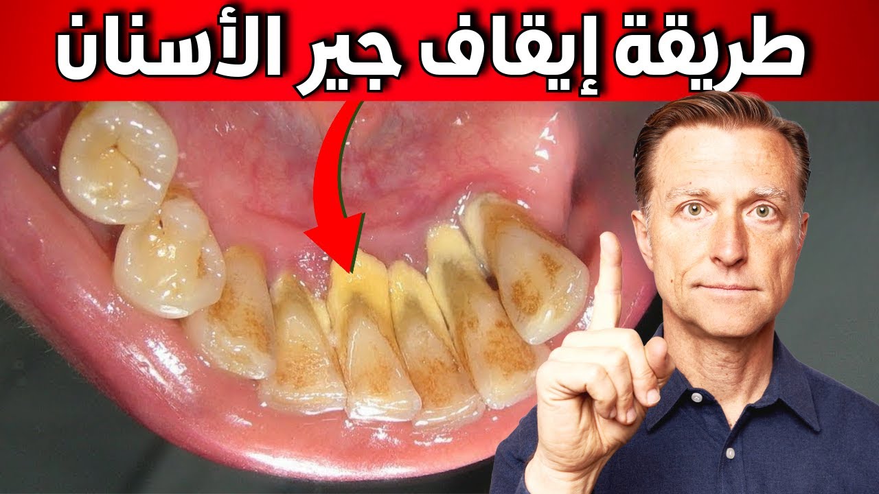 وجود هذا في أسنانك ليس أمر طبيعي | طريقة منزلية لتتخلص منه بشكل نهائي