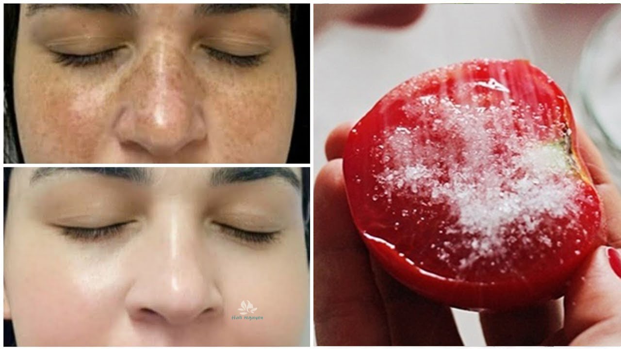 Sau 3 ng&agrave;y n&aacute;m da t&agrave;n nhang BAY SẠCH VĨNH VIỄN da trắng b&oacute;c mịn m&agrave;ng - C&aacute;ch trị n&aacute;m da t&agrave;n nhang