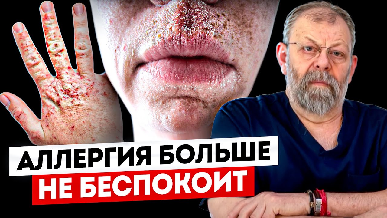 Всё про АЛЛЕРГИЮ. Как вылечить? Что делать? 3 способа воздействия на аллергию.