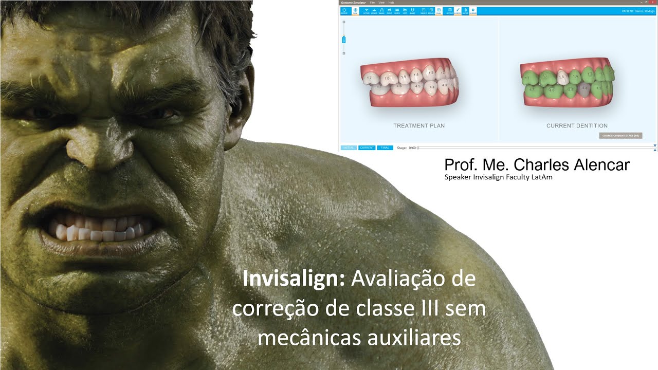 INVISALIGN: Tratamento de classe III somente com Invisalign