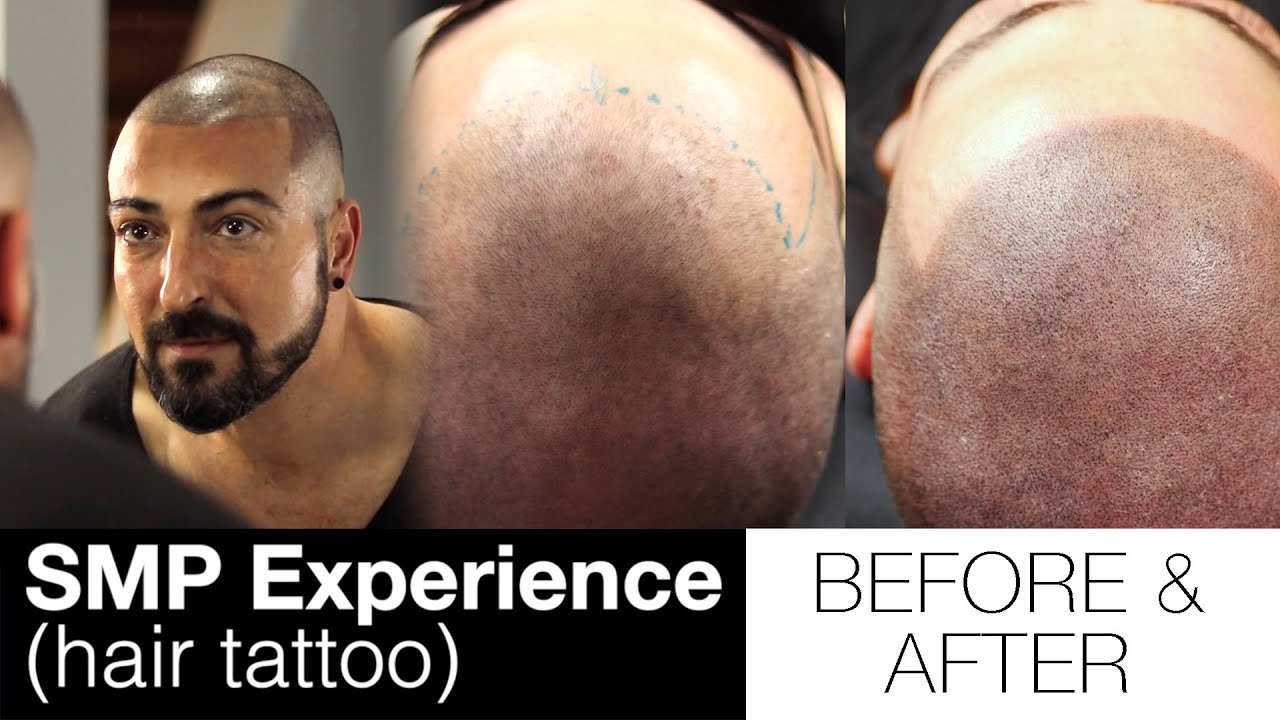 Getting a Hair Tattoo (BEFORE & AFTER) - My Experience with Scalp Micropigmentation