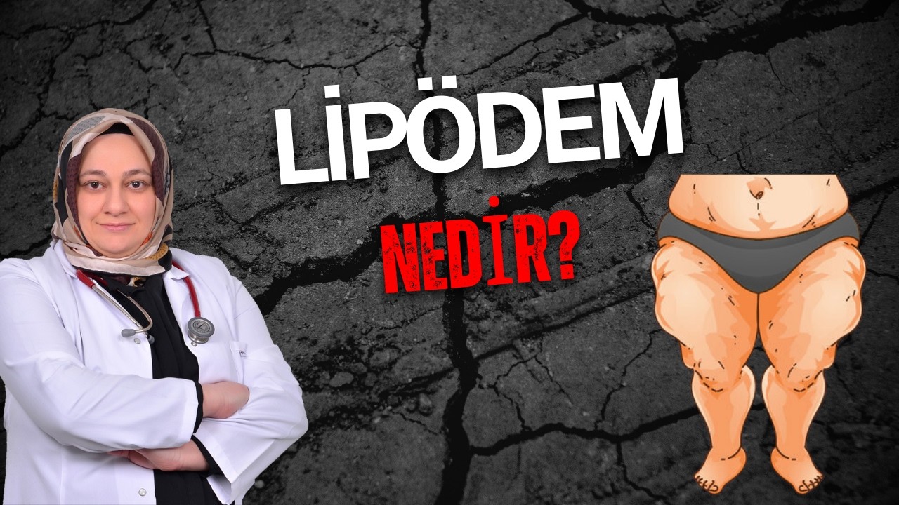 Lipödem Nedir? | Lipödem Evreleri, Belirtileri ve Tedavisi