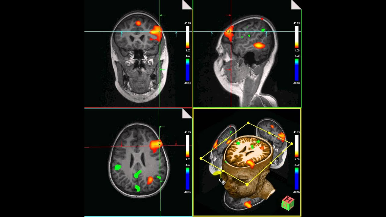 fMRI