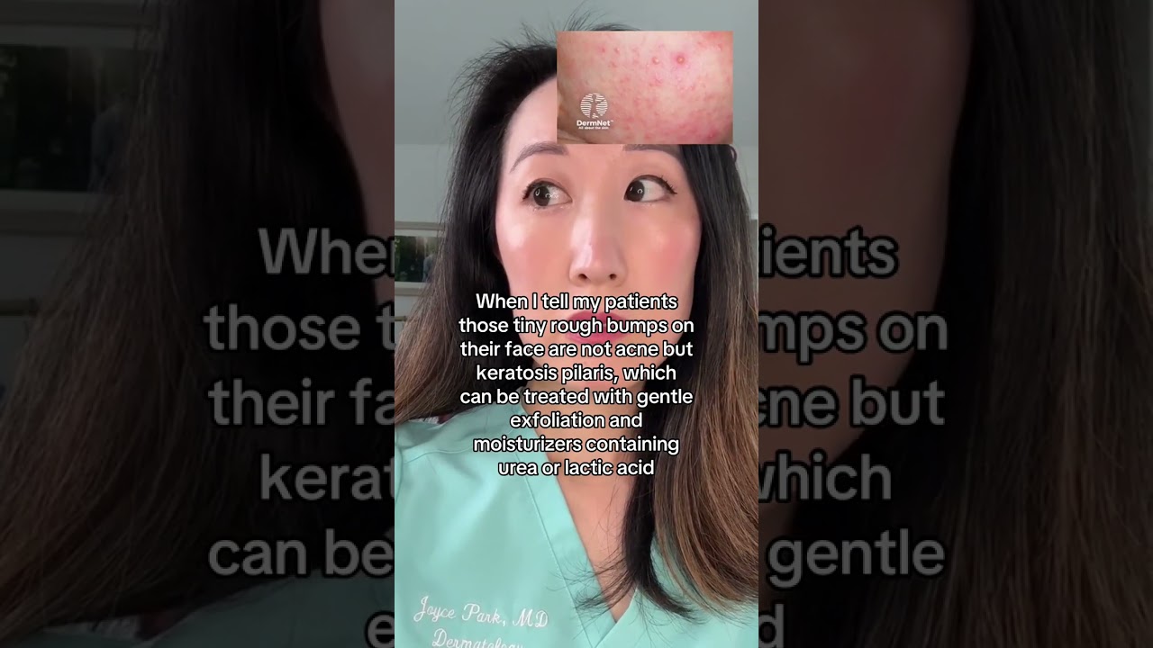 Those Tiny Bumps on Your Face? It&rsquo;s KP, Not Acne &ndash; Here&rsquo;s What to Do