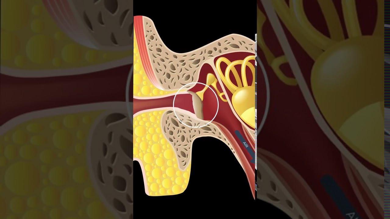 RETRACTED EARDRUM/RETRACTION POCKETS EXPLAINED #SHORTS