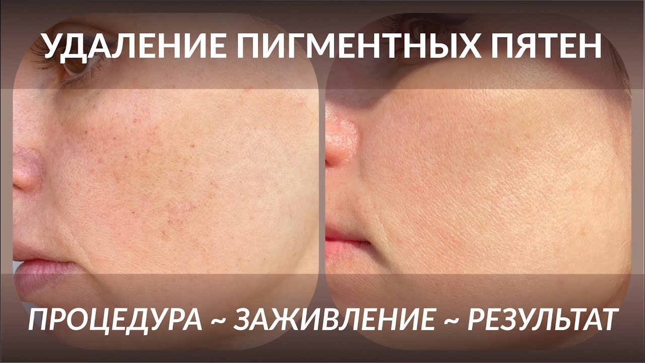 Лечение пигментации на аппарате, фототерапия пигментных пятен, результат 1 процедуры