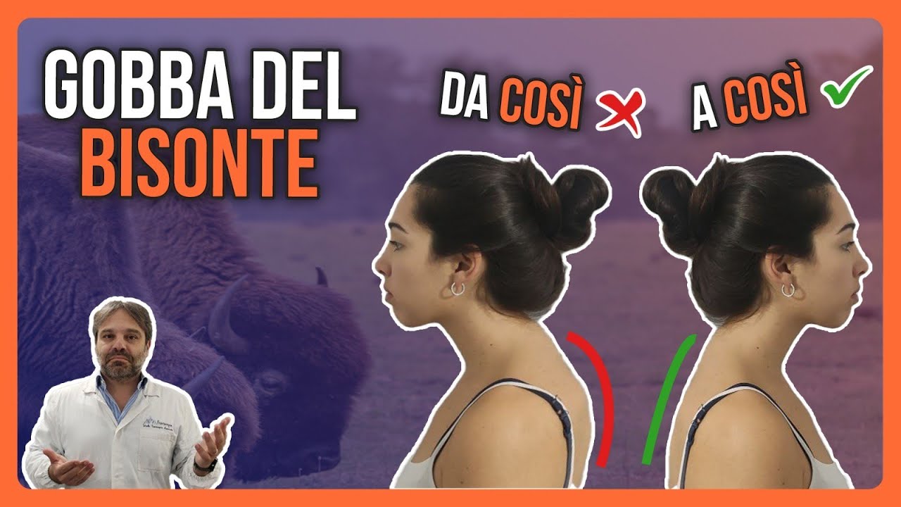 Come CURARE la GOBBA con solo 3 ESERCIZI | FUNZIONA