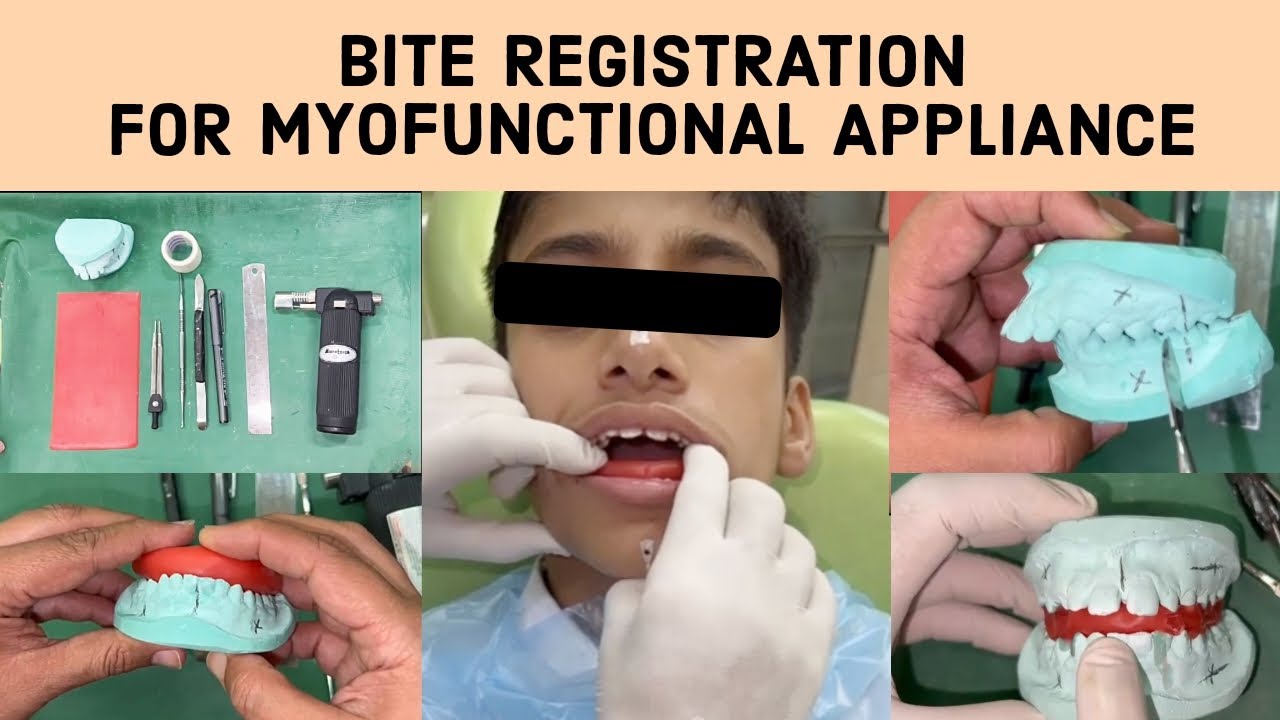 🔵 Step by Step Demonstration on  Bite Registration For Myofunctional Appliance in Orthodontics