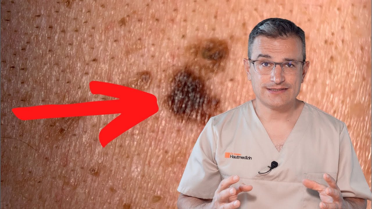 Hautkrebs (Melanom) oder harmloses Hautmal? Im Anfangsstadium erkennen. Dr. Kasten Mainz