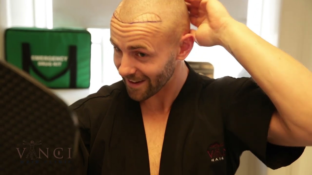 What to expect on the day of your hair transplant with Adam Aveling