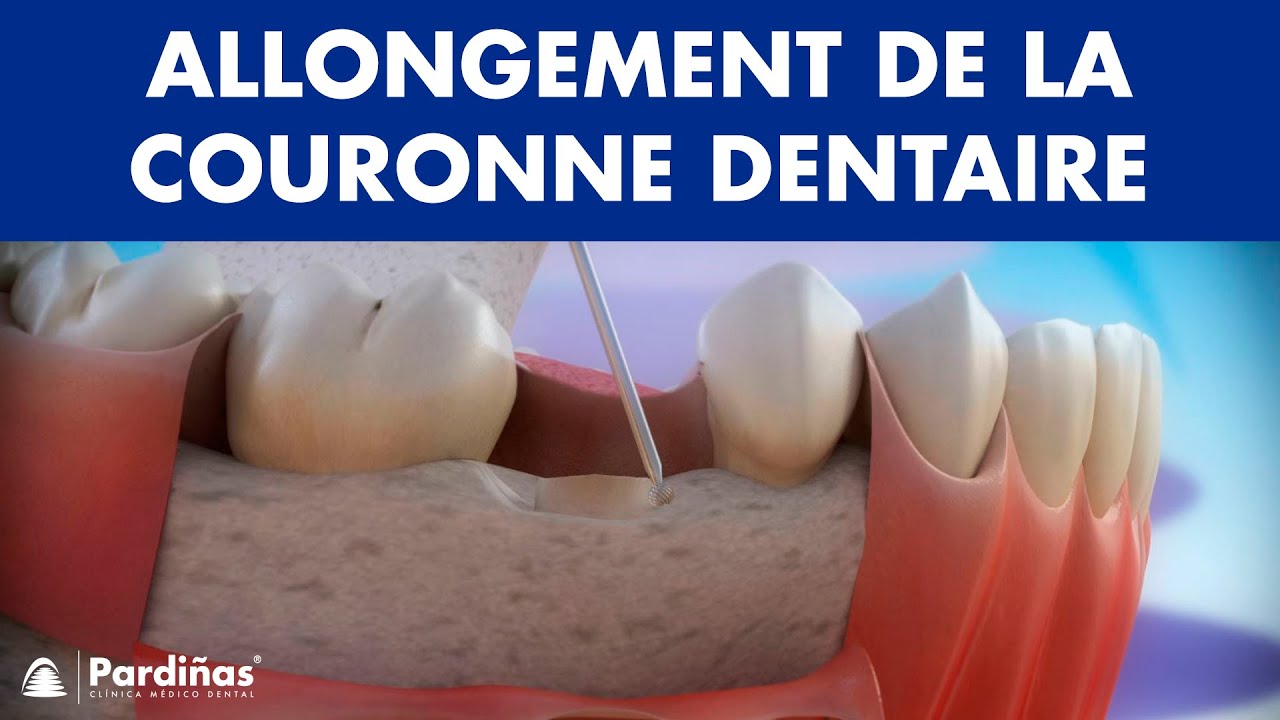 Allongement de la couronne dentaire ©