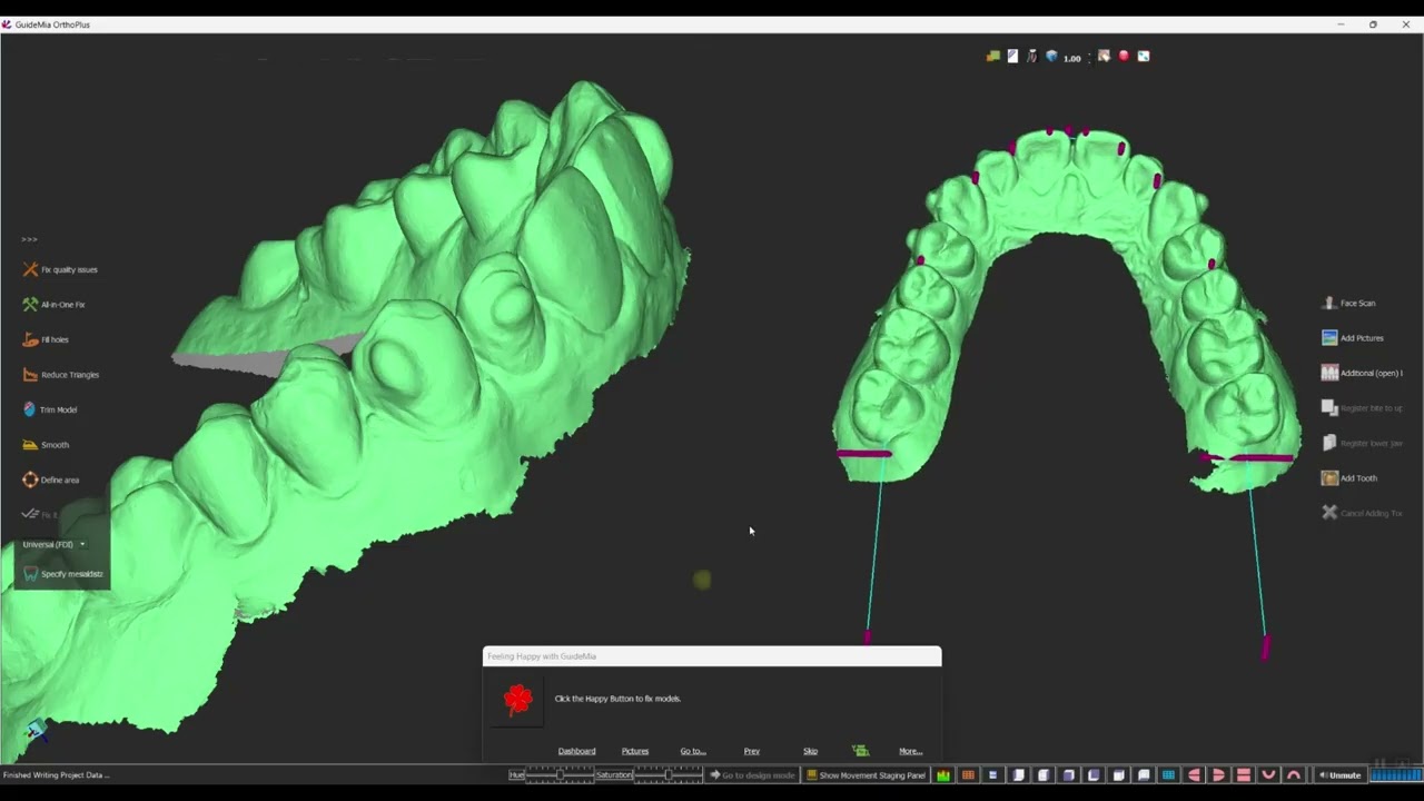 GuideMia OrthoPlus Model Touchup