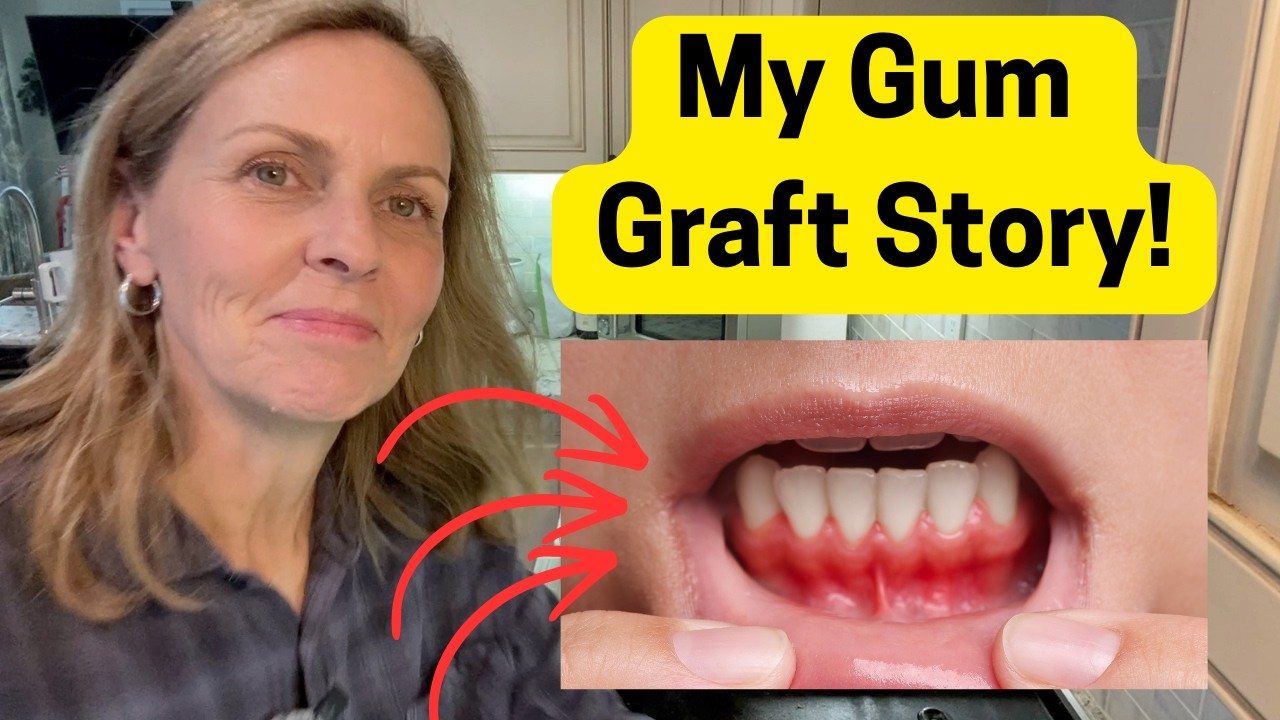I Was Terrified of Gum Graft Surgery… Here’s How It Went (Part 1)