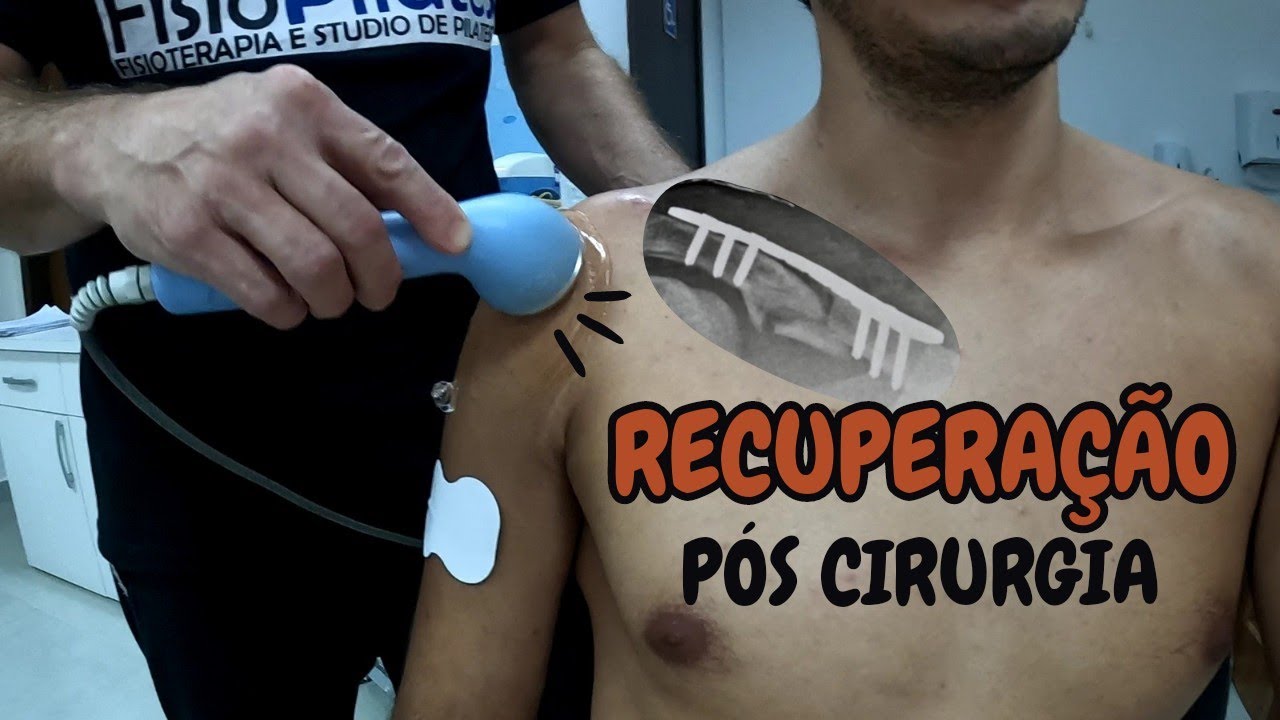 Como está a RECUPERAÇÃO após o Acidente de MOTO | Fratura da Clavícula - Fisioterapia e Tratamento