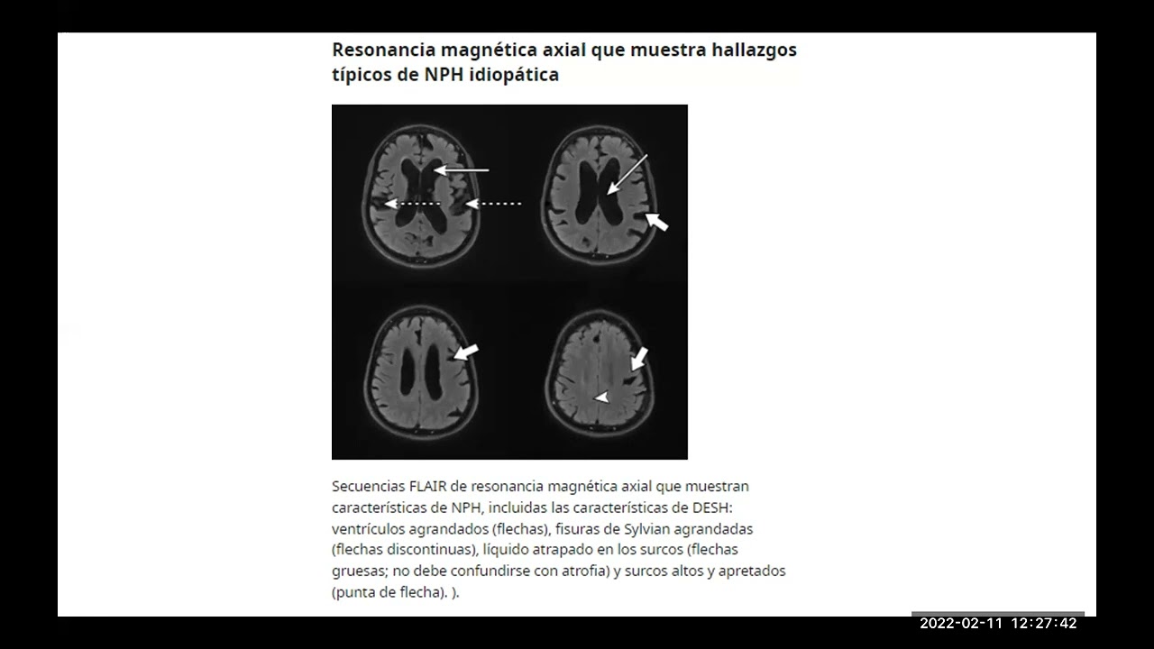 HIDROCEFALIA NORMOTENSIVA
