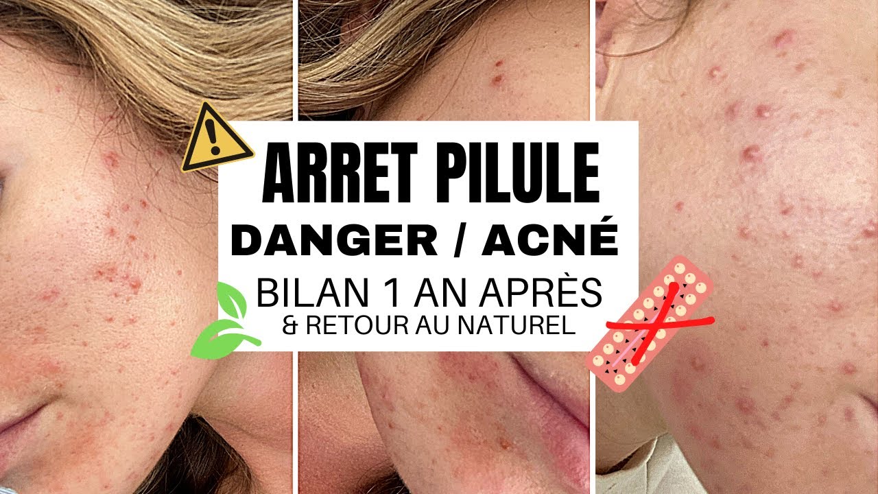 ARRET PILULE : DANGER, ACNÉ,  Bilan un an après, solutions naturelles, conseils, santé en danger !