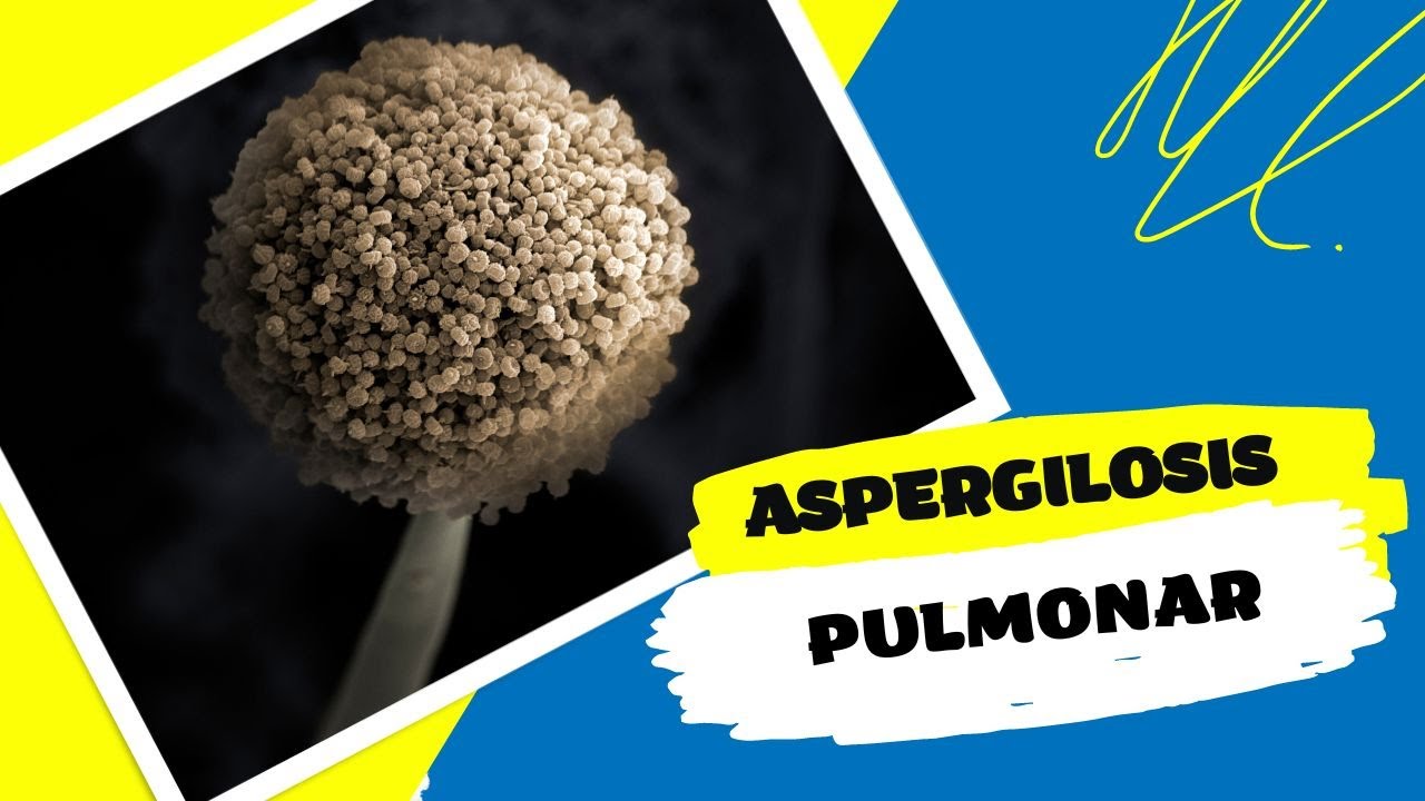 Aspergilosis Pulmonar, un hongo invasivo