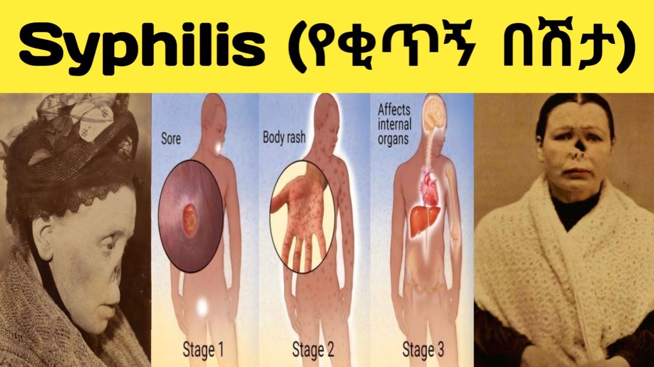 #Syphilis. Grade 9 Biology Lesson Unit 4. (#የቂጥኝ በሽታ 9ኛ ክፍል ባዮሎጂ ትምህርት ምዕራፍ 4) #Ethiopianeducation.