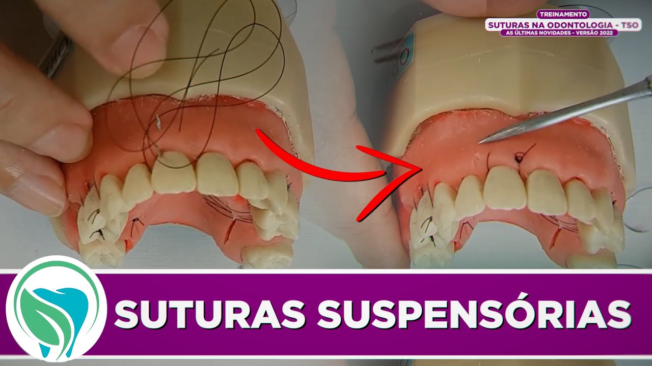 Como realizar Suturas Suspensórias na odontologia | Aula prática