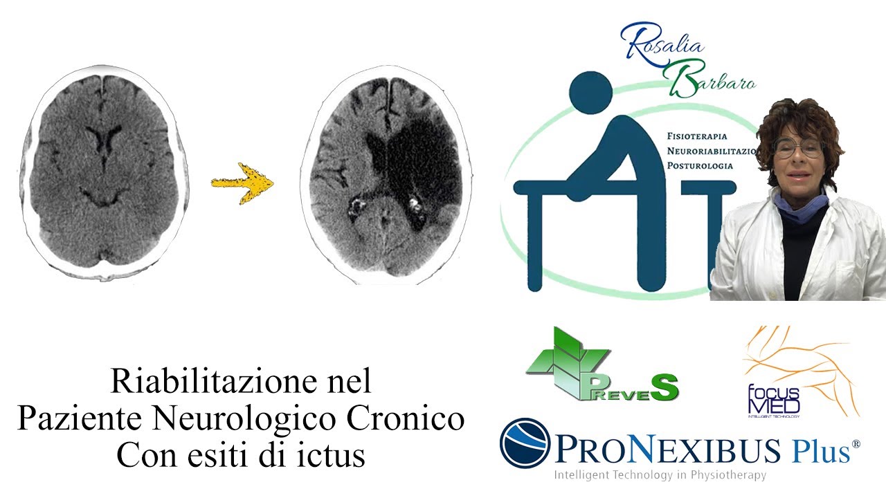 Ipertono e spasticità post ictus: quali approcci o terapie? Dr.essa Ft. Barbaro Rosalia