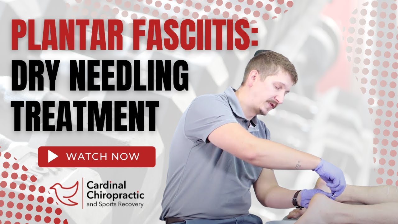 Plantar Fasciitis: Dry Needling Treatment - Your Burlington NC Chiropractor