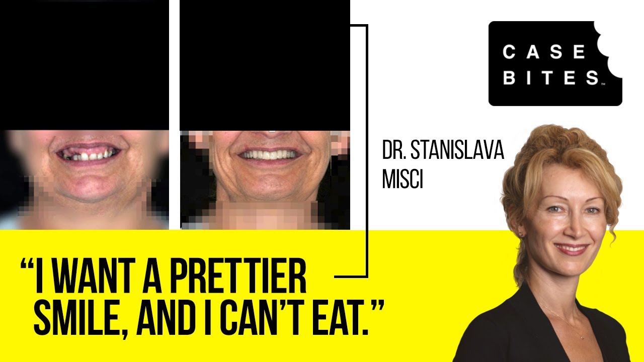 Case Bite #4: The Edentulous Patient: Evaluation & Planning for Fixed Implant Full Arch Restoration