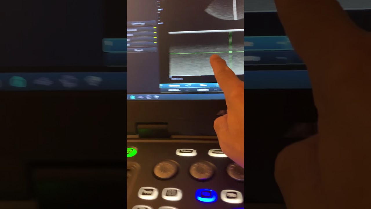 Alpinion Ecube i7, cardiac measurements. Part 1: 2D and M mode