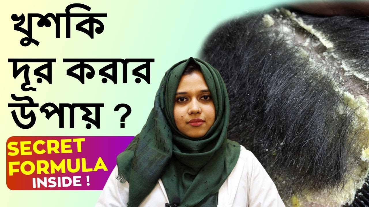 DANDRUFF SOLUTIONS ~ খুশকি থেকে কিভাবে মুক্তি পাওয়া যাবে ? #dandruff