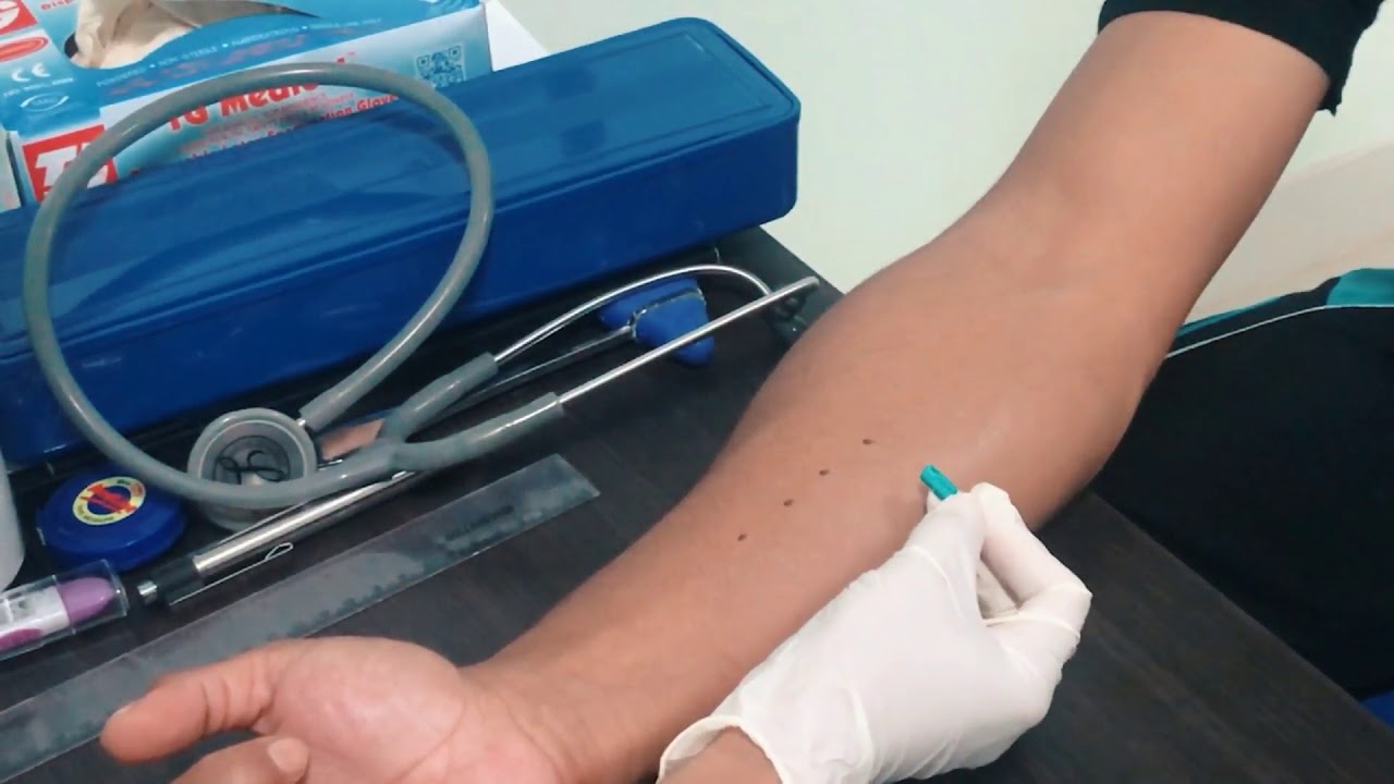 SKIN PRICK TEST