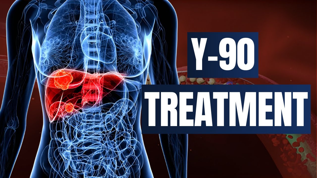 Understanding Y90 Radioembolization