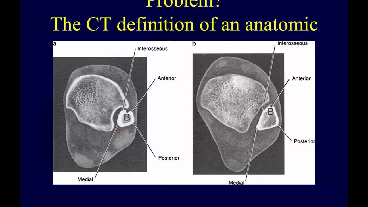 Malleolar ankle fractures - posterior malleolus and syndesmosis  (OTA lecture series III l12c)