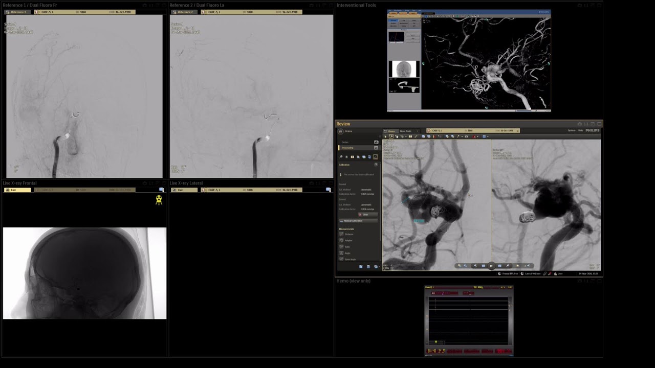 Case-5, ICA-MCA aneurysm, 04-03-2026