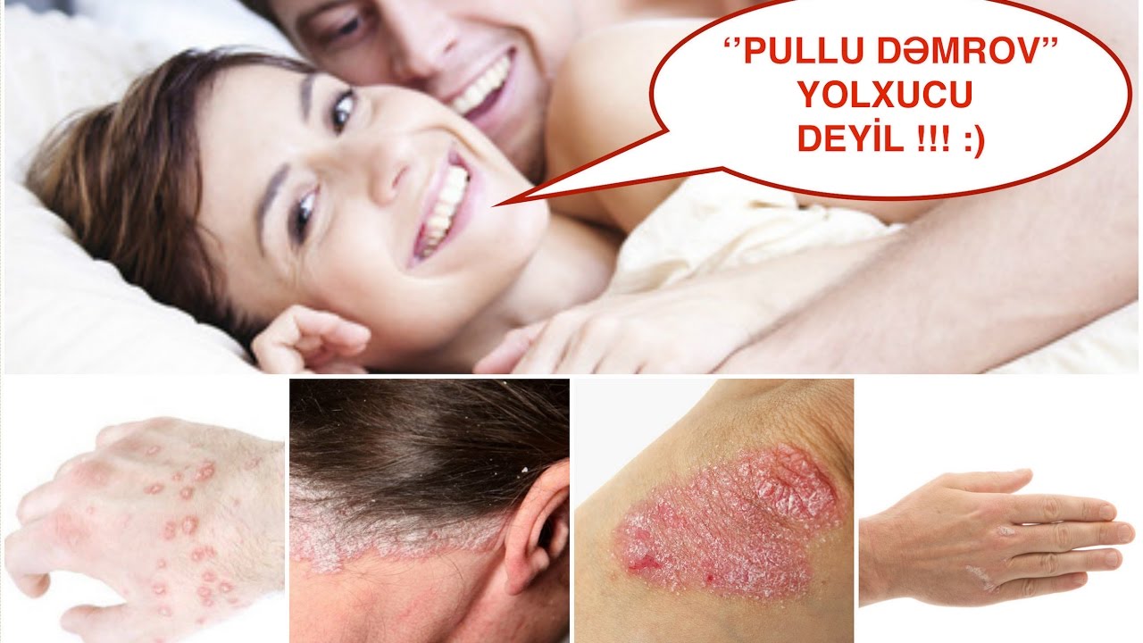 Pullu dəmrov / Psoriaz yolxucu xəstəlikdirmi ?
