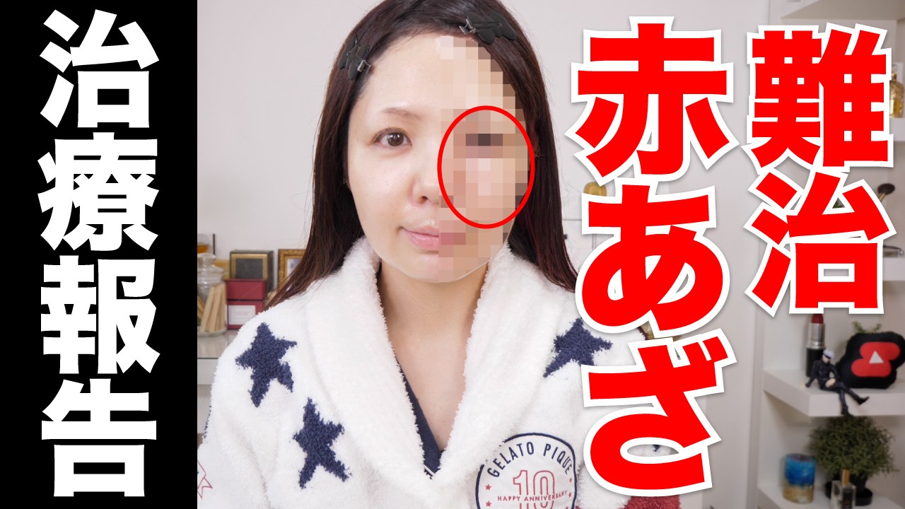 【レーザー治療】ついに4回目！難治と言われたポートワイン母斑（赤アザ）の経過全部お見せします【3ヶ月間の長期企画】